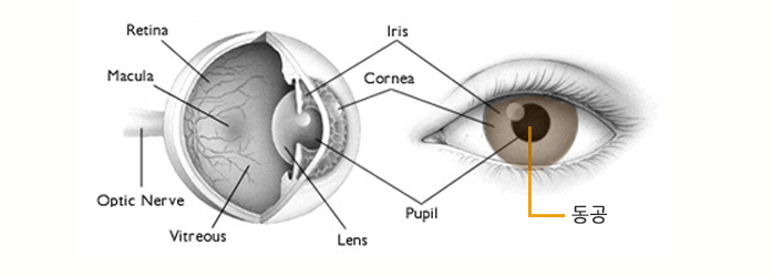 동공 크기에 따른 수술방법